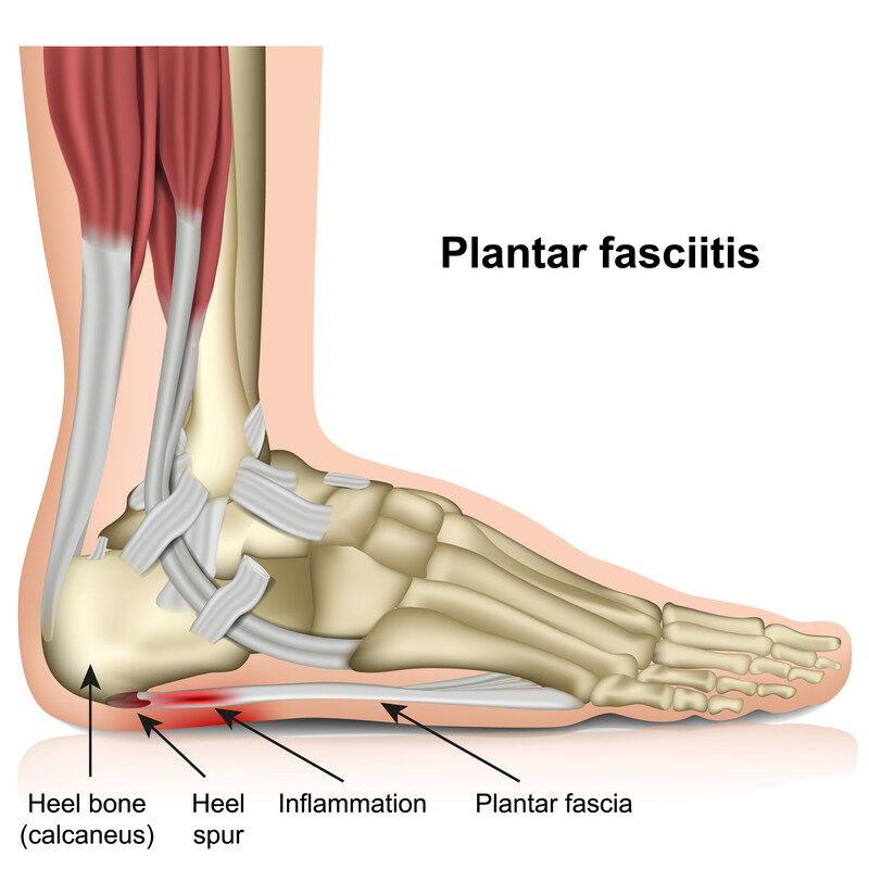plantar fasciitis plantar fasciitis