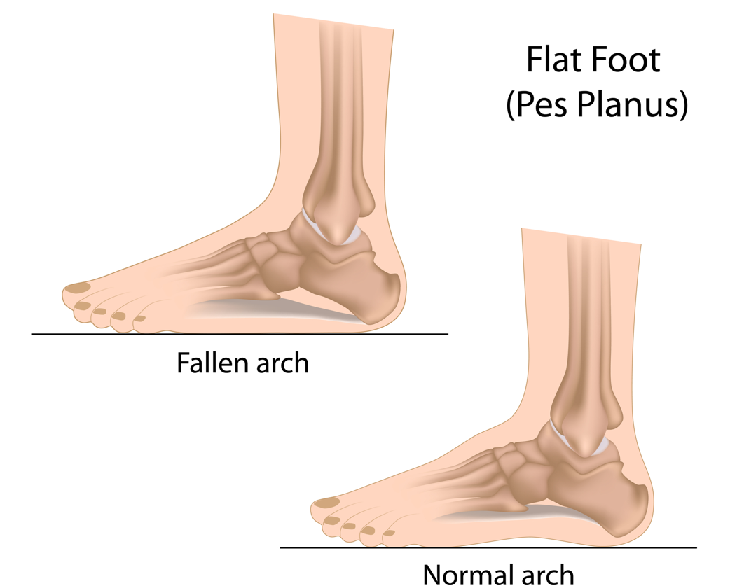 flat foot vs normal arch