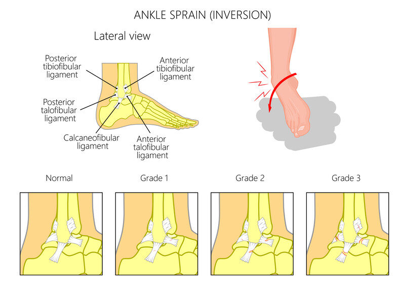 sprained ankle